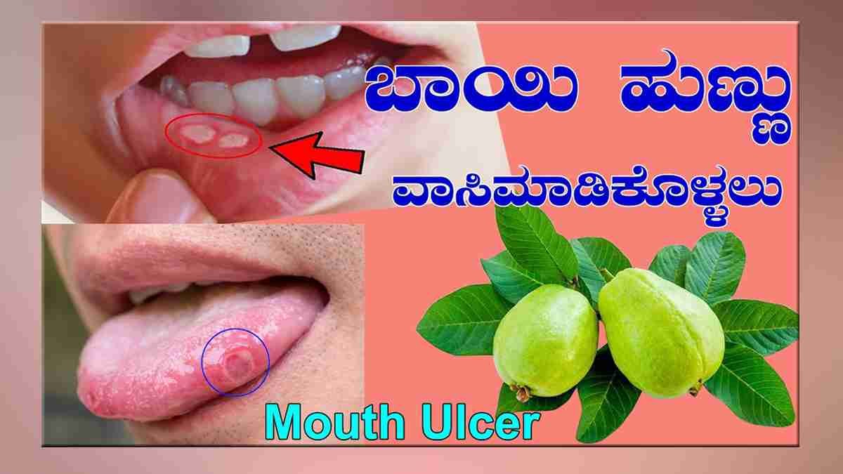 ಬಾಯಿ ಹುಣ್ಣು ಸಮಸ್ಯೆಗೆ 3 ಮನೆಮದ್ದುಗಳು..!