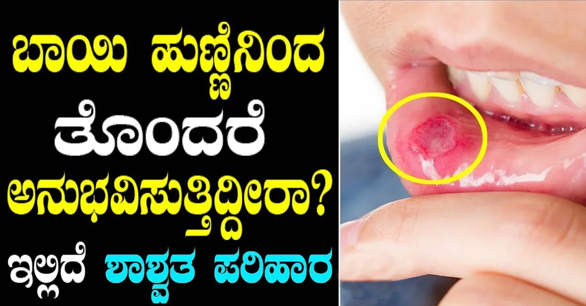 ಬಾಯಿ ಹುಣ್ಣು ಸಮಸ್ಯೆಗೆ 3 ಮನೆಮದ್ದುಗಳು..! 1 bayi hunnu
