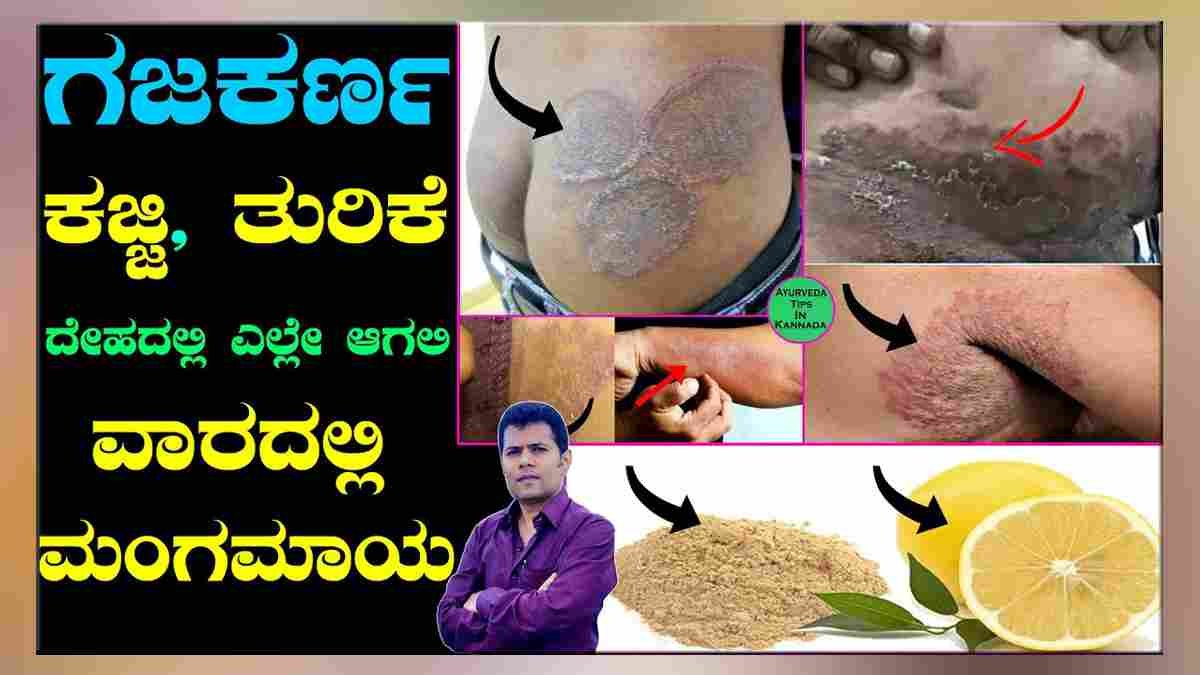 ಗಜಕರ್ಣ / ಕಜ್ಜಿ /ತುರಿಕೆಗೆ ಮನೆಮದ್ದು..!