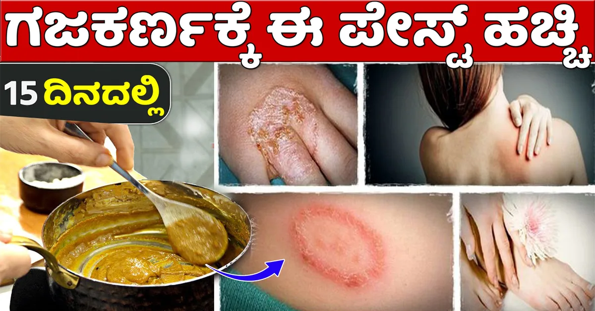 ಗಜಕರ್ಣ / ಕಜ್ಜಿ /ತುರಿಕೆಗೆ ಮನೆಮದ್ದು..!