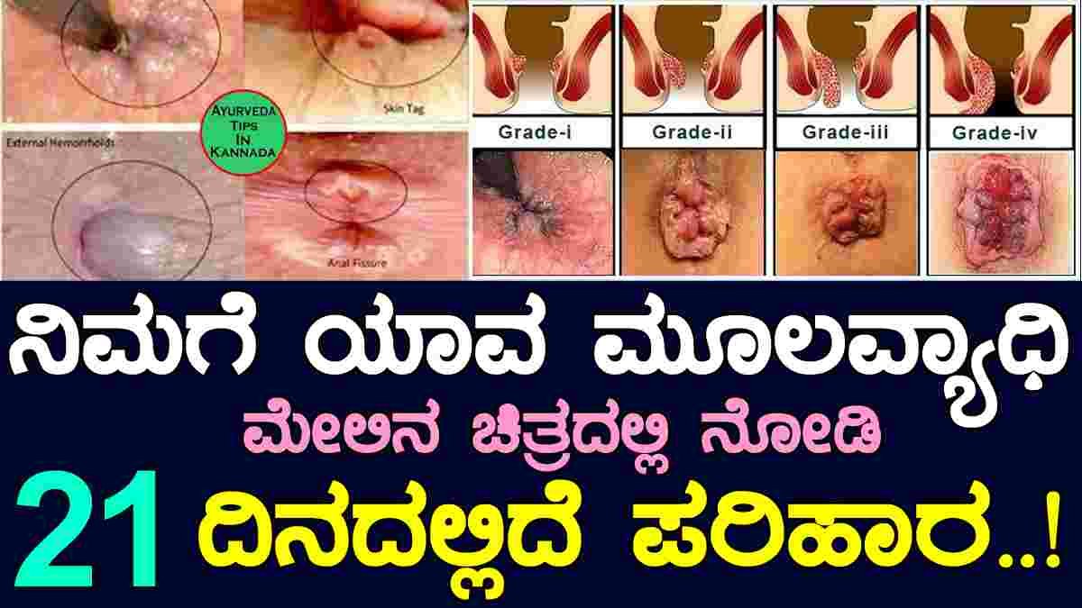 ಆಪರೇಷನ್ ಮಾಡಿಸದೆ ಮೂಲವ್ಯಾಧಿ 21 ದಿನದಲ್ಲಿ ಮಂಗಮಾಯ..!