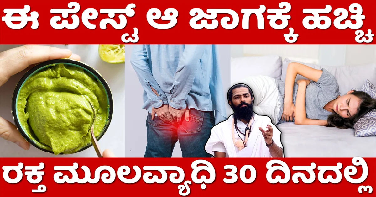 ಆಪರೇಷನ್ ಮಾಡಿಸದೆ ಮೂಲವ್ಯಾಧಿ 21 ದಿನದಲ್ಲಿ ಮಂಗಮಾಯ..!