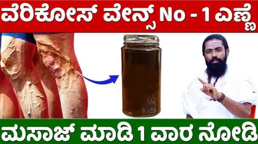 Varicose Veins Treatment in Kannada