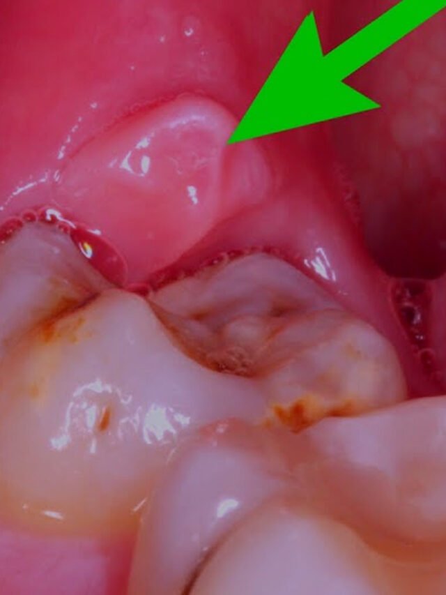 ಹಲ್ಲು ನೋವಿಗೆ ಮನೆಮದ್ದು  / Teeth Pain Kannada