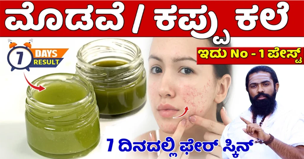 ಈ ಕ್ರೀಮ್ ಹಚ್ಚಿ 7 ದಿನದಲ್ಲಿ ಮೊಡವೆ, ಕಪ್ಪು ಕಲೆ ಮಾಯ..! - AYURVEDA TIPS IN KANNADA Clear Pimples
