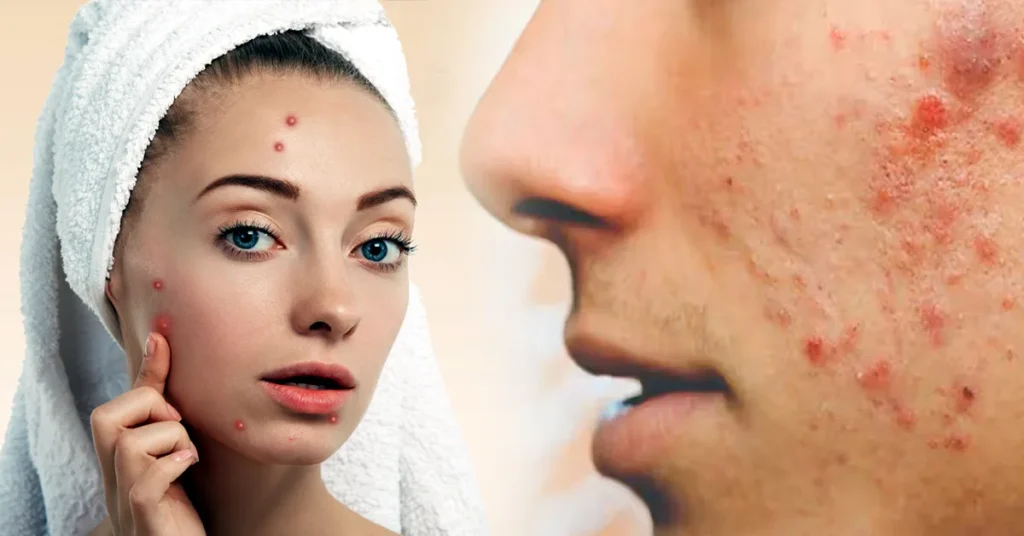 ಈ ಕ್ರೀಮ್ ಹಚ್ಚಿ 7 ದಿನದಲ್ಲಿ ಮೊಡವೆ, ಕಪ್ಪು ಕಲೆ ಮಾಯ..! - AYURVEDA TIPS IN KANNADA Clear Pimples