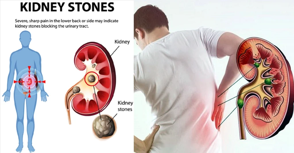 Kidney Stone Kannada