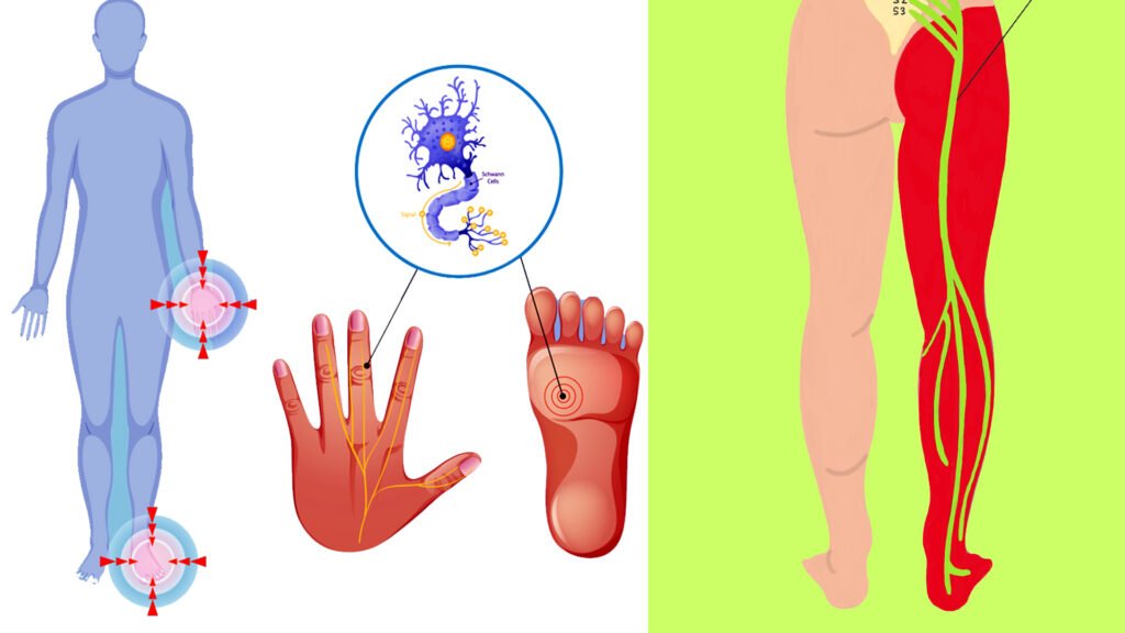 Nerve Weakness in Kannada